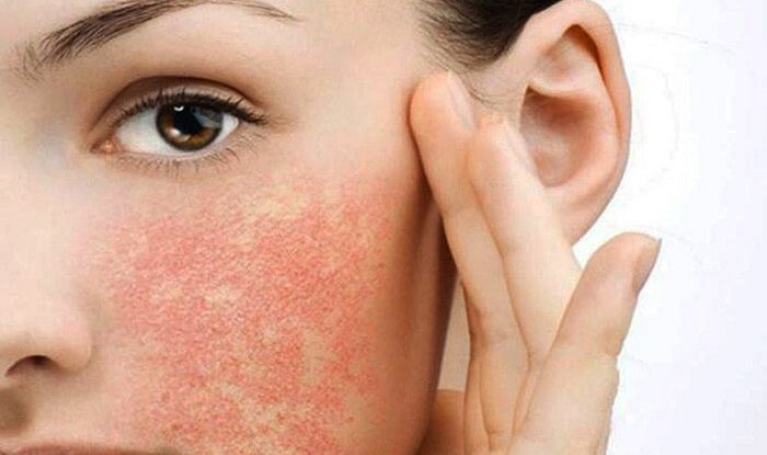 Thời gian và tốc độ phục hồi da mặt cháy nắng tùy thuộc vào tình trạng da và cách chăm sóc