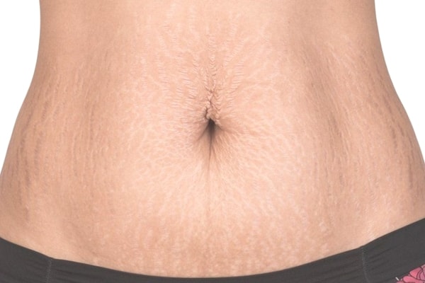 Da bụng bị đen sau sinh thường do ảnh hưởng của nội tiết tố thay đổi