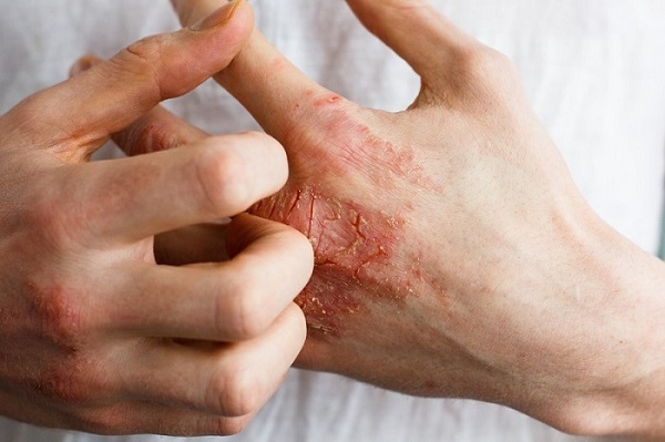 Làn da sau khi dùng kem lột trắng không có khả năng “tự vệ” nên rất dễ bị nhiễm độc